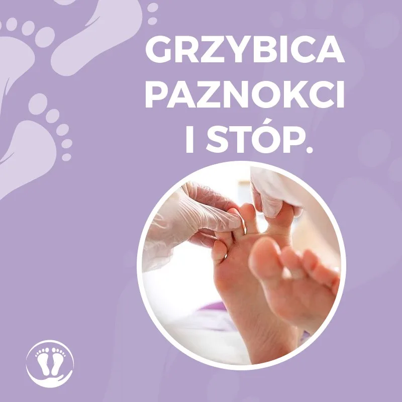 Grzybica paznokci i stóp