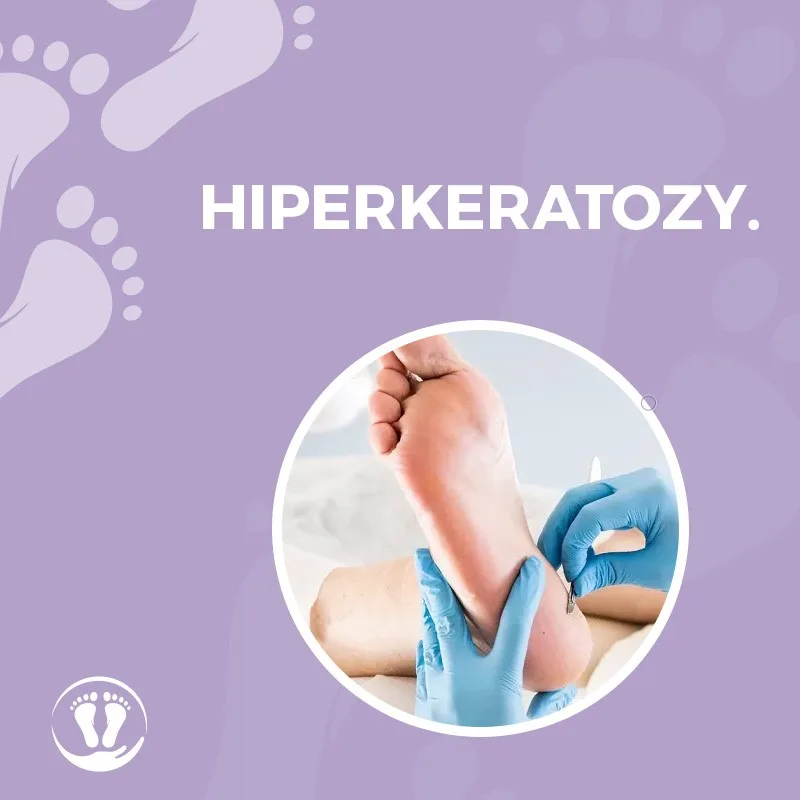 Hiperkeratozy