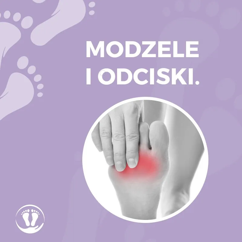 Modzele i odciski