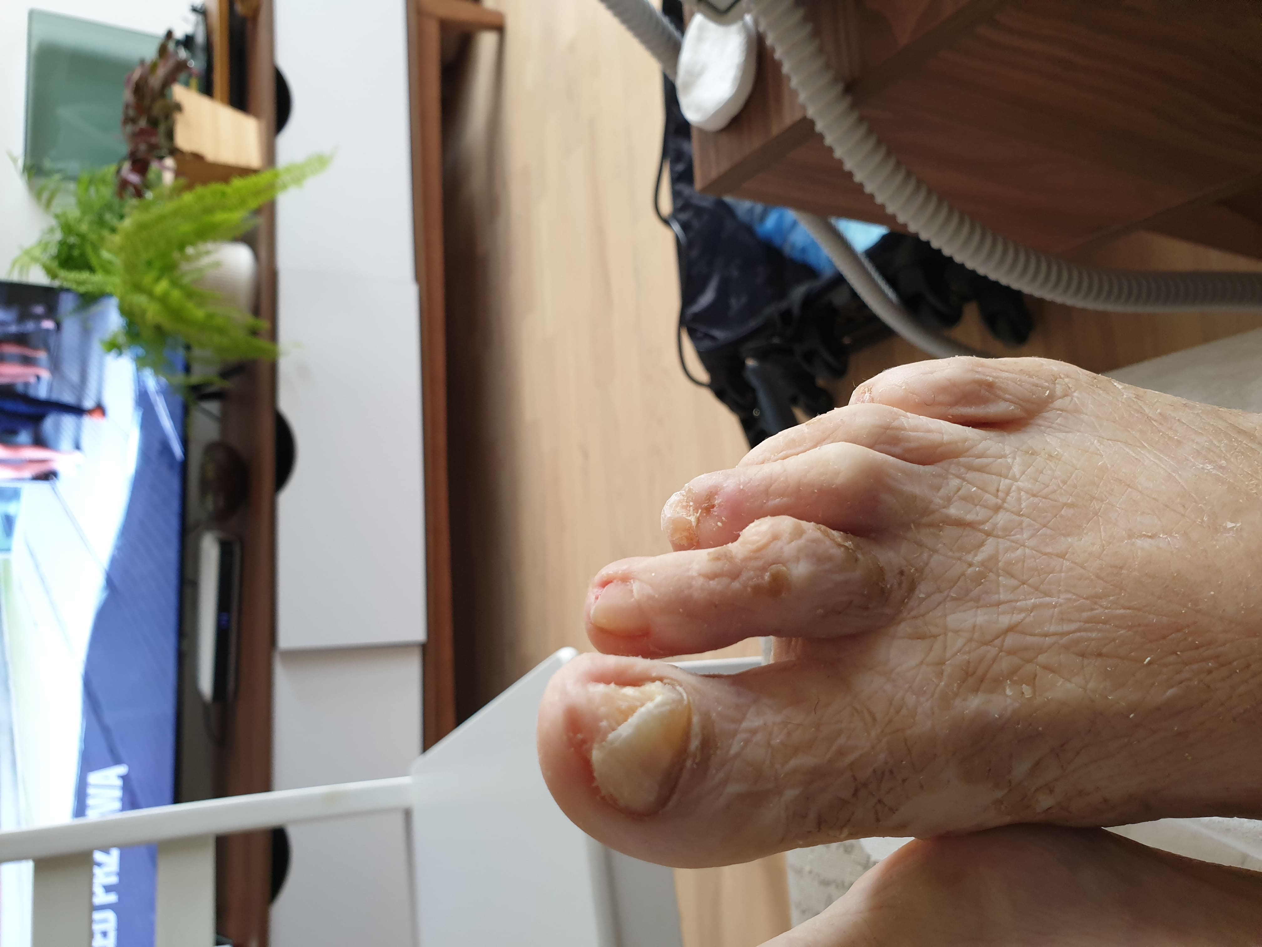 Stopy pacjenta po zabiegu podologicznym — widoczna poprawa