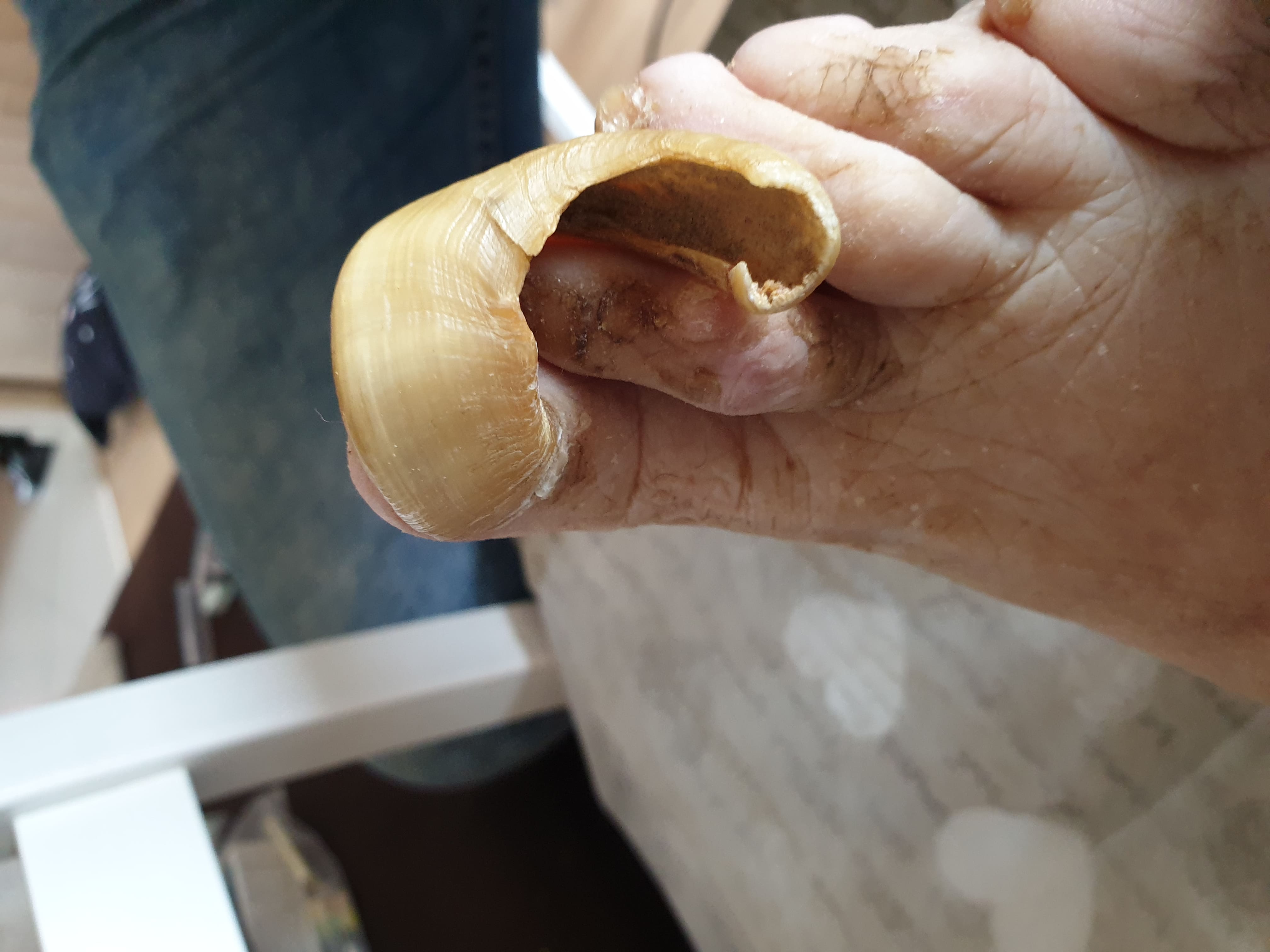 Stopy pacjenta przed zabiegiem podologicznym — stan wyjściowy