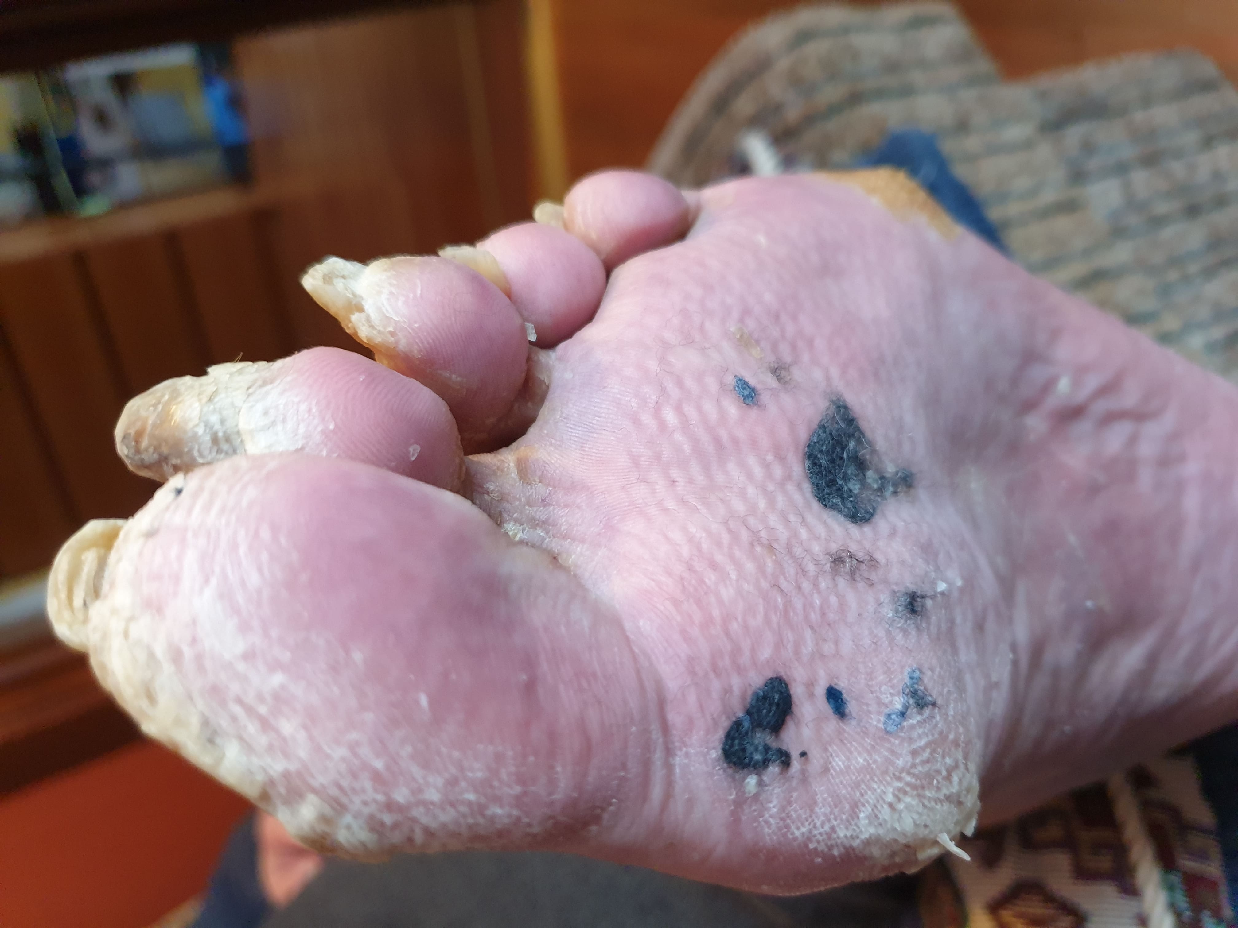 Zaawansowana deformacja paznokci — „bawoli róg” przed zabiegiem